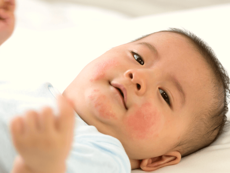 Baby eczema - innobaby
