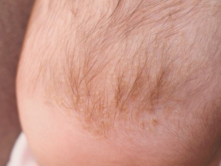 How to Treat Infant Cradle Cap at Home - innobaby