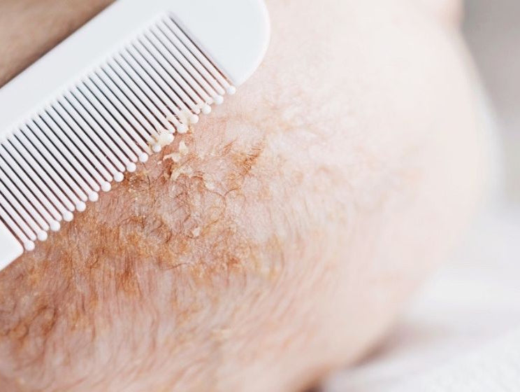 Natural and safe cradle cap solutions for baby - innobaby