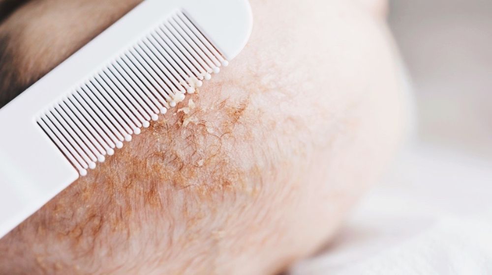 Natural and safe cradle cap solutions for baby - innobaby